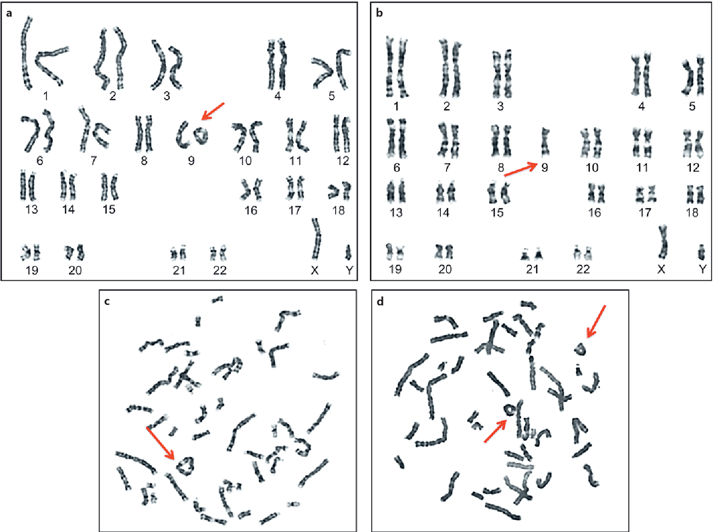 A Comprehensive And Clinical Review Of Chromosome 9 Ring Syndrome